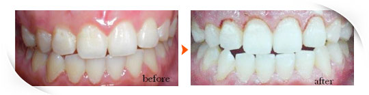 雷射牙齒美白-治療前與治療後