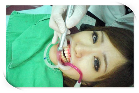 水雷射牙齦整修
